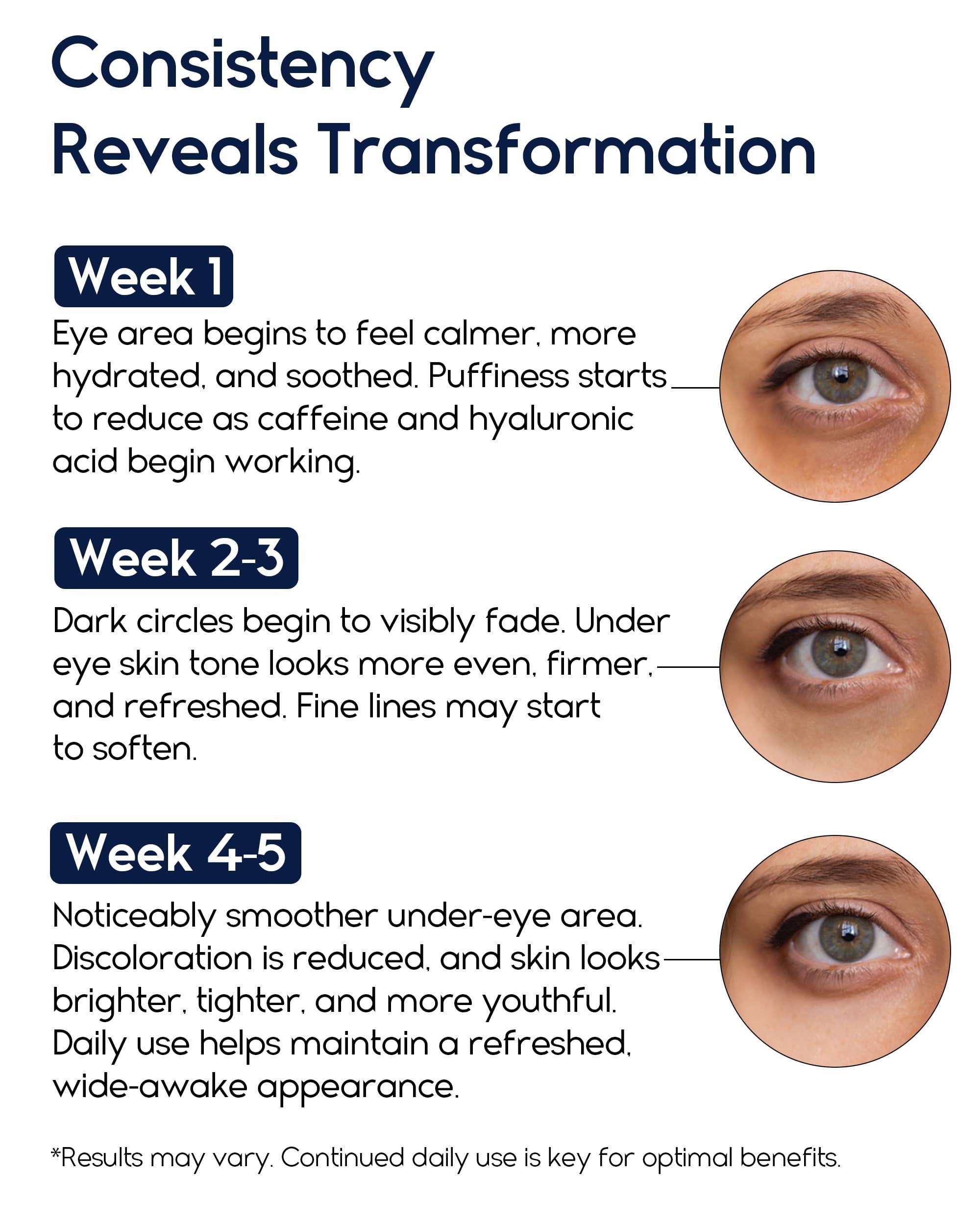 Under Eye Cream for Puffiness and Bags Under Eyes 1 fl oz Eye Bags Treatment for Men Women Anti Wrinkle Cream for Dark Circles Baggy Eyes Treatment for Women with Retinol Hyaluronic Acid & Caffeine