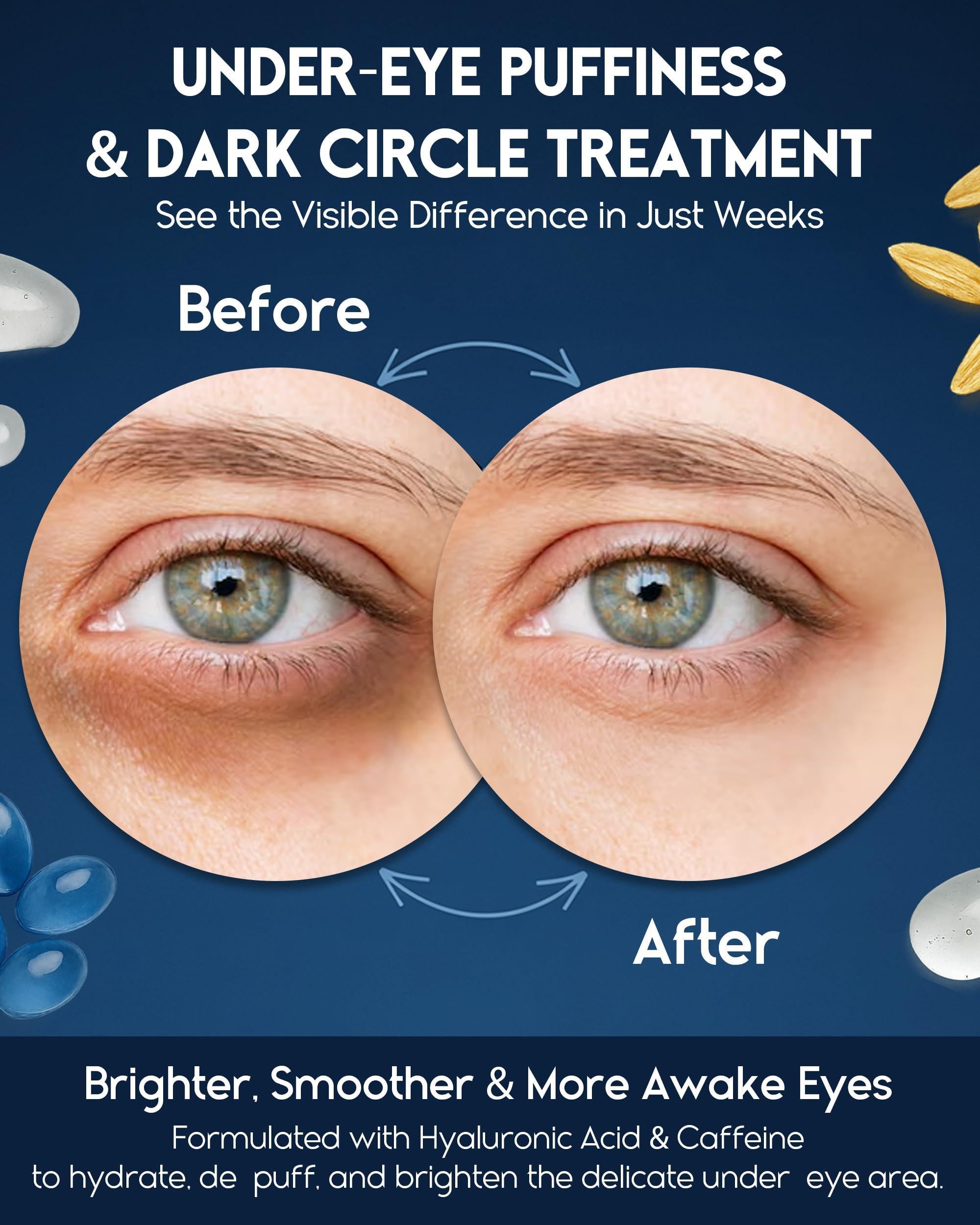 Under Eye Cream for Puffiness and Bags Under Eyes 1 fl oz Eye Bags Treatment for Men Women Anti Wrinkle Cream for Dark Circles Baggy Eyes Treatment for Women with Retinol Hyaluronic Acid & Caffeine